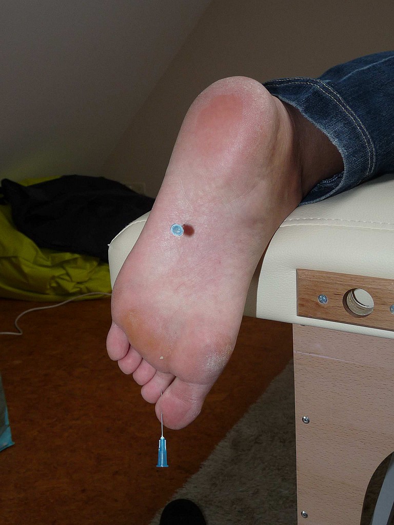 The Pain Files Amateur Needle Pain 포르노 사진 #428602822 | The Pain Files Pics, Feet, 모바일 포르노