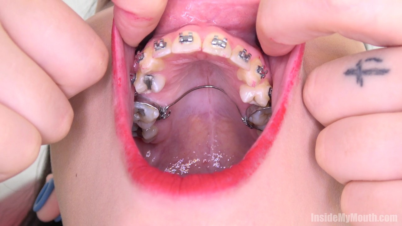 Brunette with dental braces opens wide for close up views of her big mouth foto porno #424966041