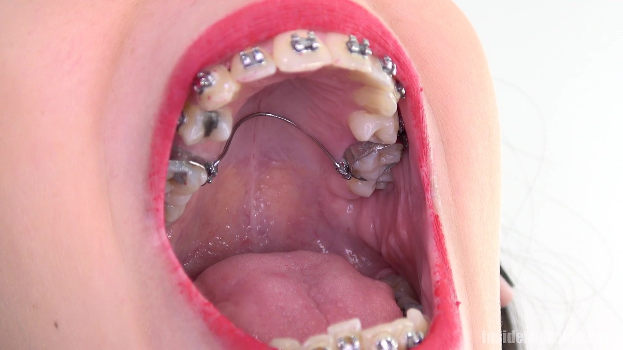 Brunette with dental braces opens wide for close up views of her big mouth porn photo #424966063