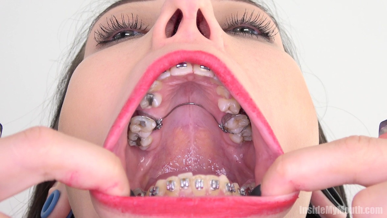 Brunette with dental braces opens wide for close up views of her big mouth 色情照片 #424966066